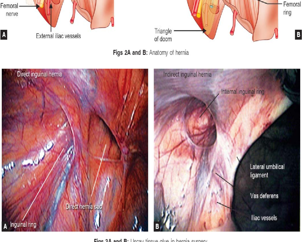 laparoscopic-inguinal-hernia