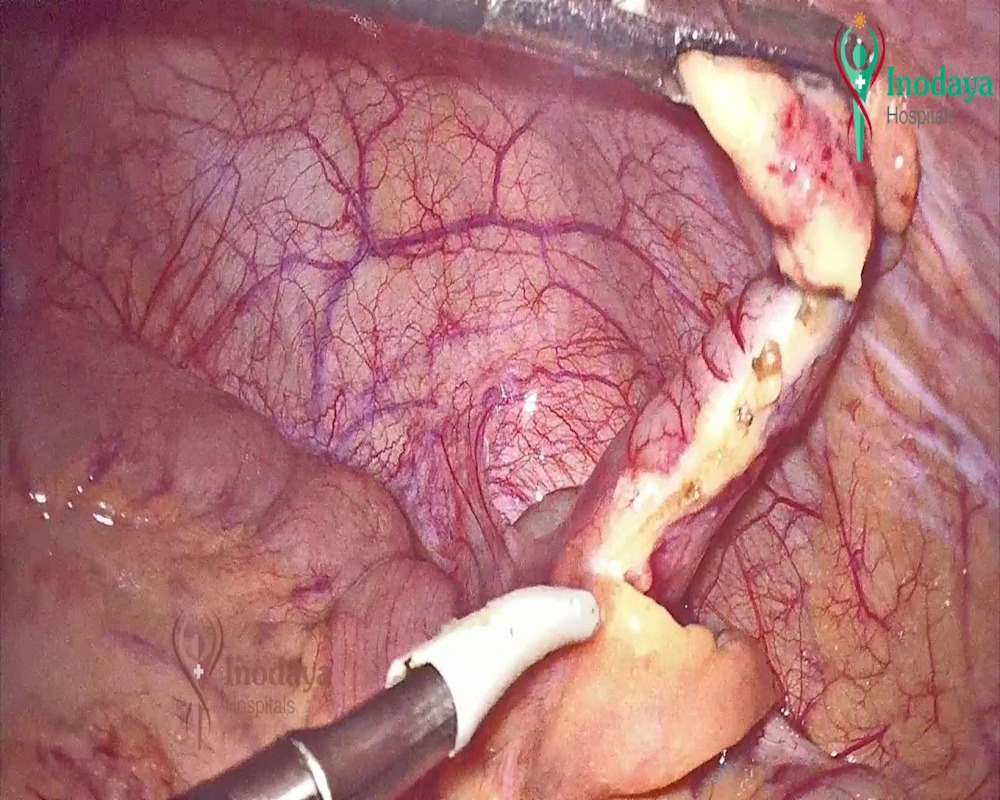 laparoscopic-appendectomy