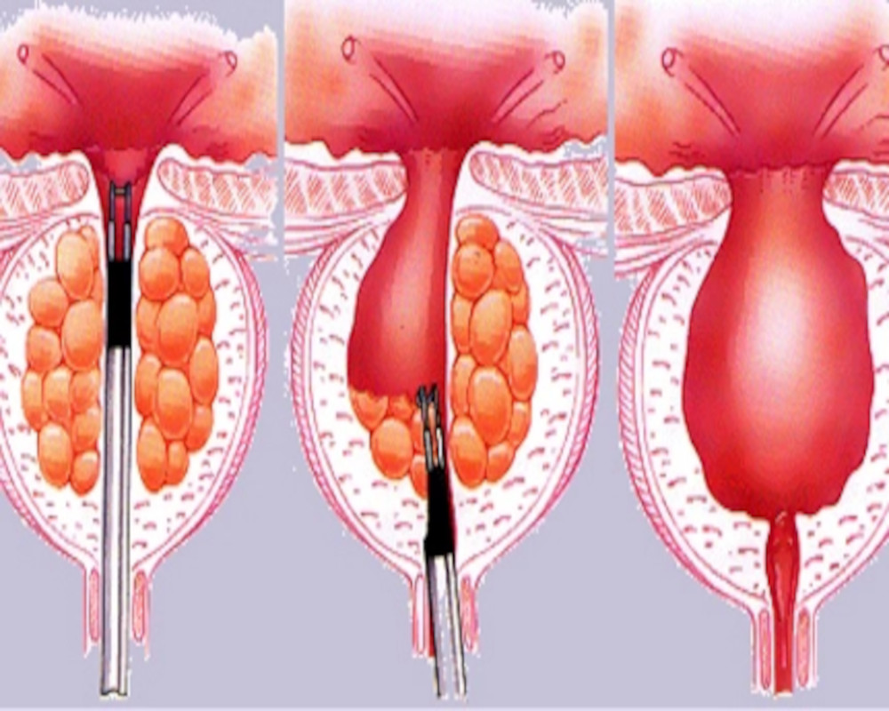 turp-for-benign-prostate-surgery