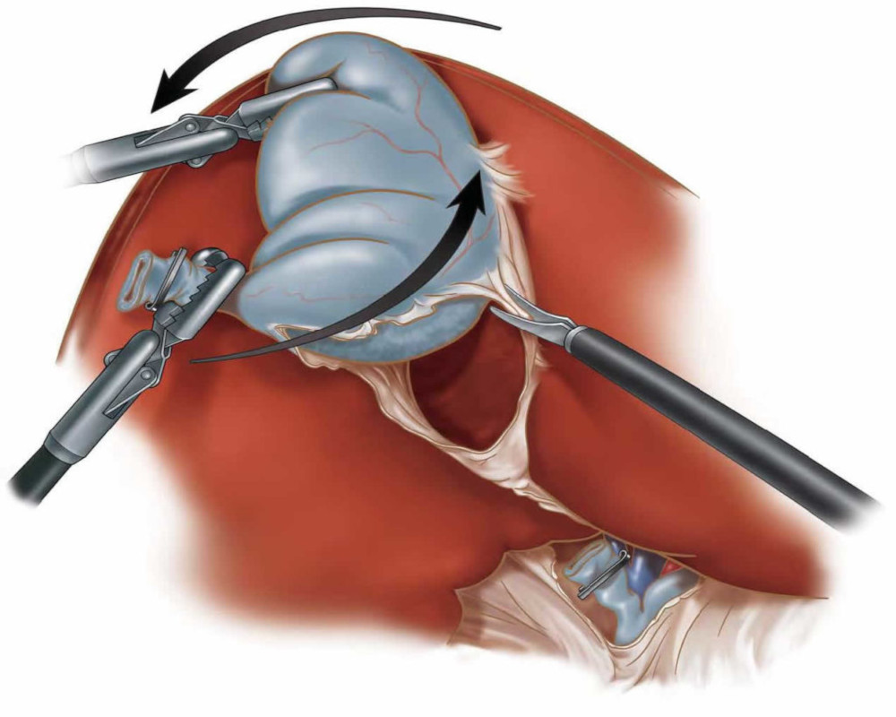 laparoscopic-cholecystectomy