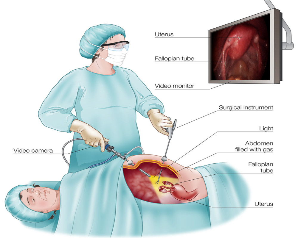 laparoscopic-hysterectomy-ot