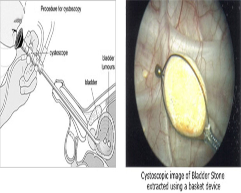 bladder-stone-surgery