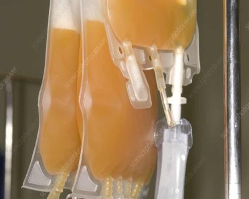 jumbo-platelet-transfusion