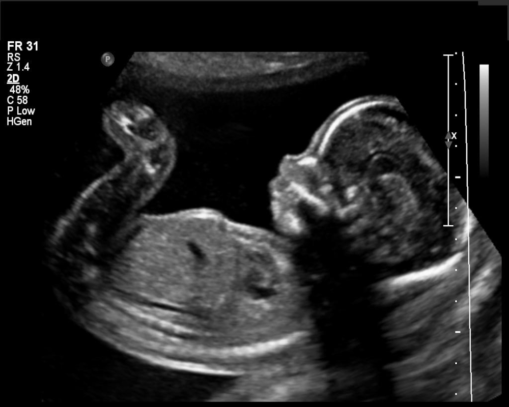 anc-ultrasound